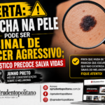 ALERTA: Mancha na Pele Pode Ser Sinal de Câncer Agressivo; Diagnóstico Precoce Salva Vidas